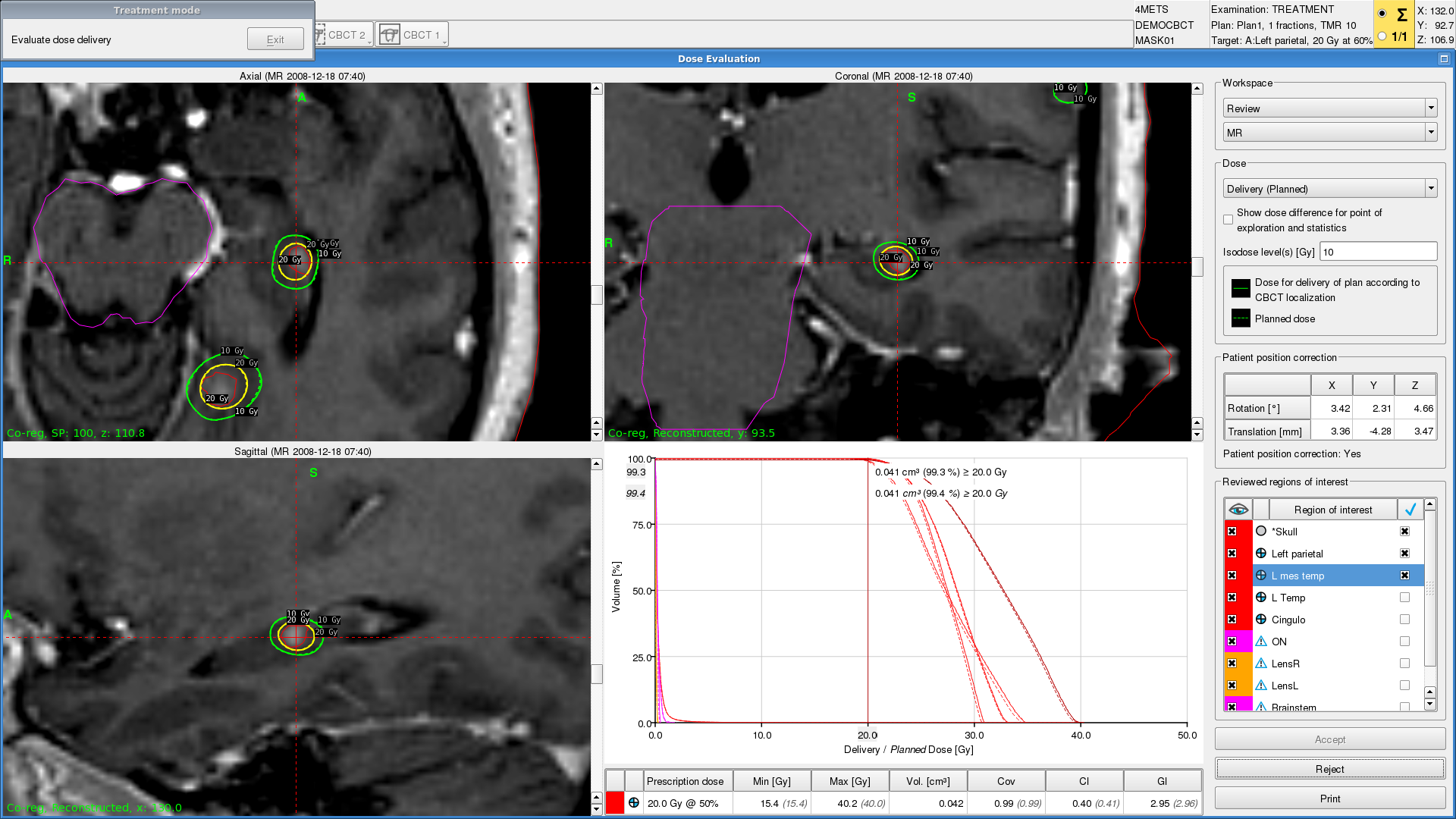 Unparalleled dose distribution with Leksell Gamma Knife Icon