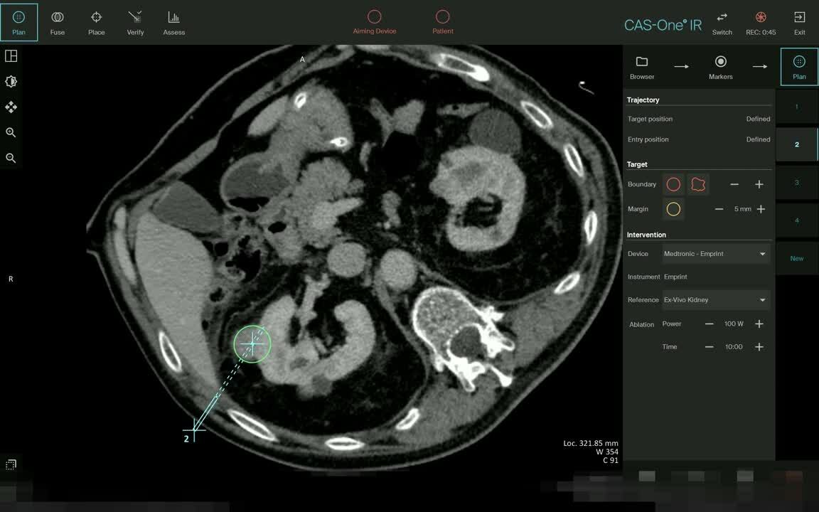 Case Haifa - Planning and Confirmation Video - Right Kidney new