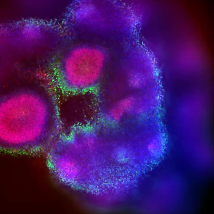 Tumoroides derivados de pacientes con cáncer de mama triple negativo en 3D 